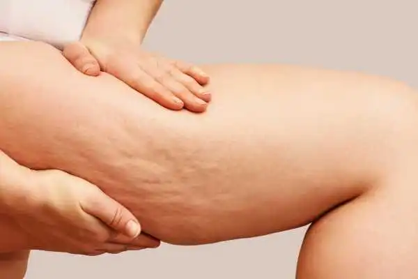Image of woman showing leg with cellulite Binley