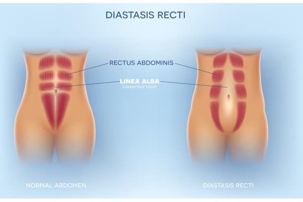 What Non-Surgical Options Are Available for Diastasis Recti Binley?