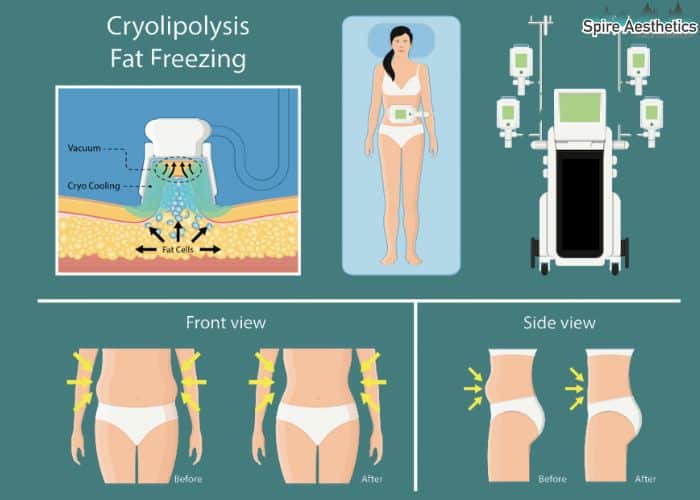 Image of diet and fat freezing combined for best results for Spire Aesthetics Binley