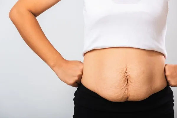 Image of a woman's stomach after weight loss with sagging skin following a gastric band Binley